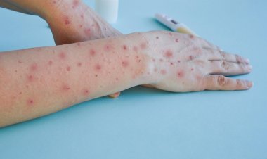 Maule: confirman primer caso de viruela del mono