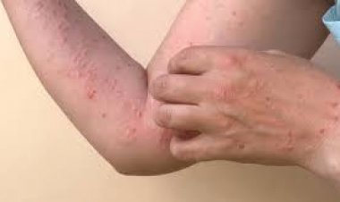 Viruela del mono: síntomas, formas de transmisión y cuidados para prevenir la enfermedad