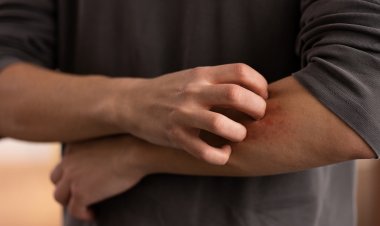 ¿Cómo tratar correctamente las picaduras de insectos o arañas?