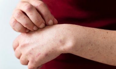 Alerta sanitaria por sarampión: una enfermedad de rápido contagio