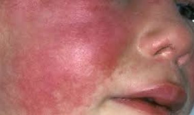 Región del Maule: Seremi de Salud ratifica casos de escarlatina en Colegio de Talca