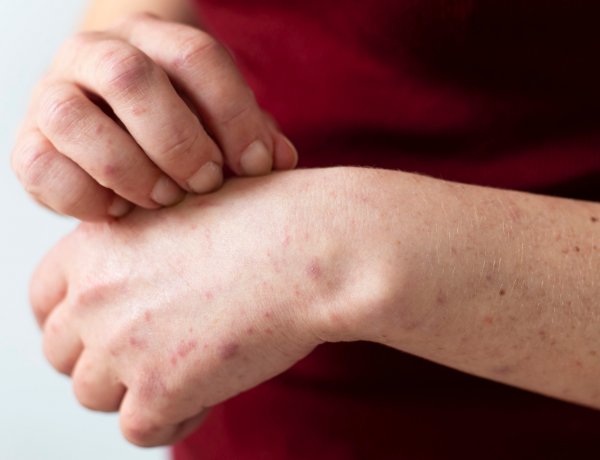 Alerta sanitaria por sarampión: ¿Quiénes deben vacunarse?